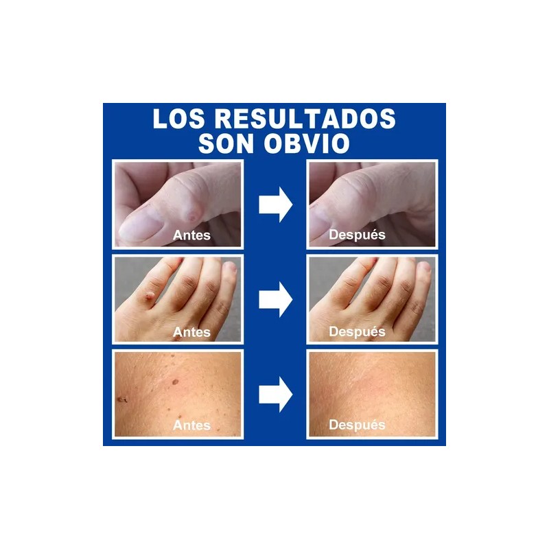 Sistema Verruga Elimina Plantar Comunes 30ml Neutra