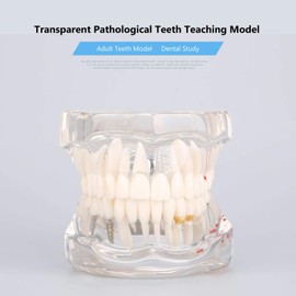 Transparent Dental Disease Model, Standard Implant Demonstration Teeth Model for Dental Disease Teaching Study, Typodont Teeth Model