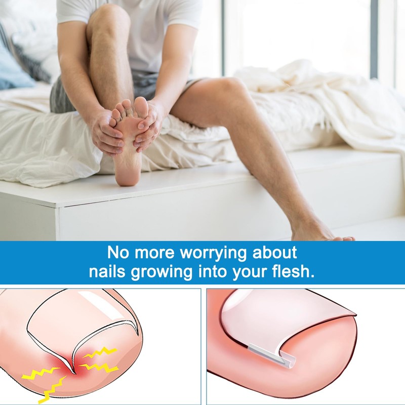 Ingrown Toenails Set, Toenail Correction Patch, Nail Clip, Toenails, Ingrown