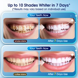 KOAEO Teeth Whitening Kit–3 Teeth Whitening Pens + 2 0123456