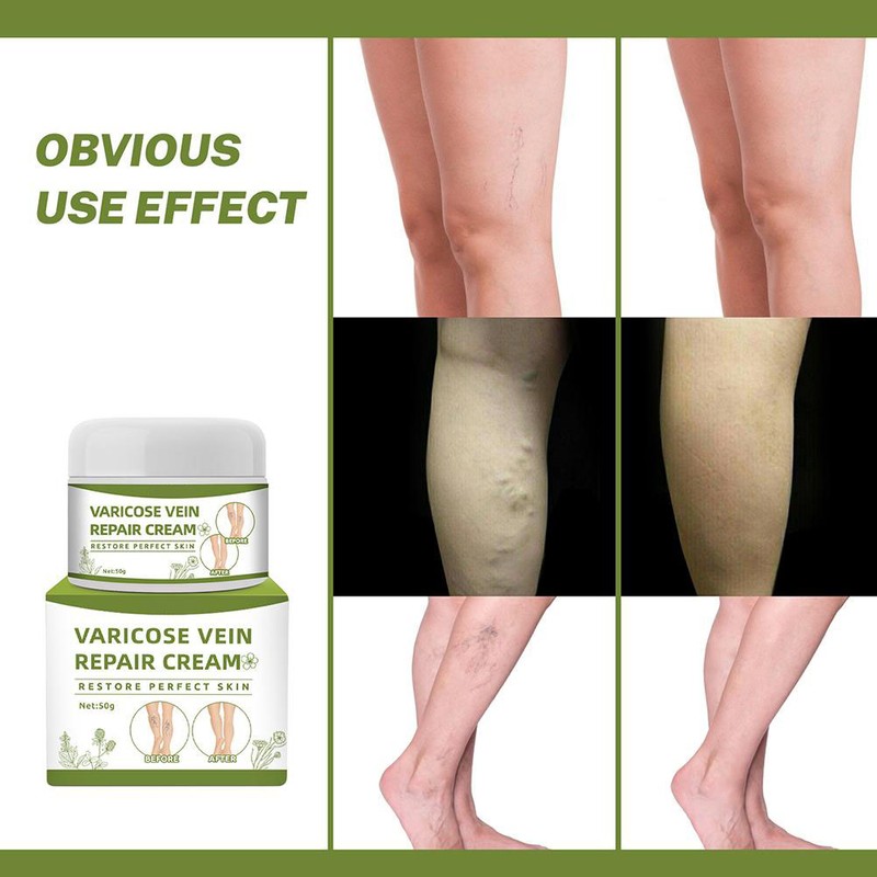 Varicose Veins Cream Natural Ointment for Varicose and Spider Veins