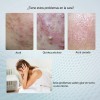 Crema Reparadora Facial 20g, Adecuada Para Piel Con Acné