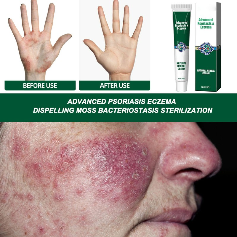 2pcs Hydrating Moisturizing Cream Eczema Erythema Repair Cream Itchy Skin