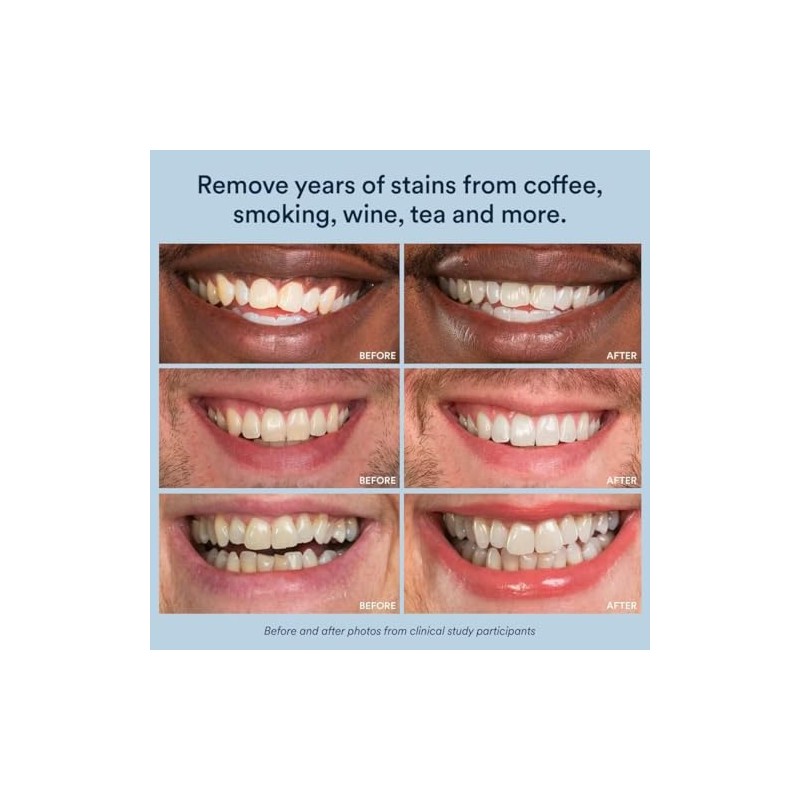 Auraglow Extra Strength Teeth Whitening Strips, Strong Whitening Strips, 14