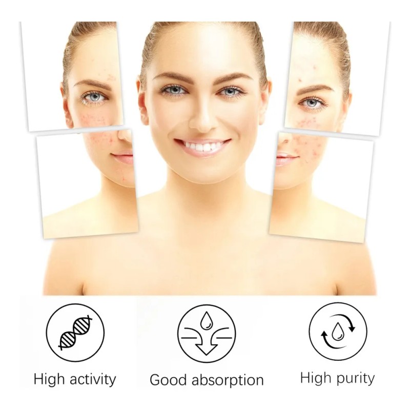 3×crema Para Tratar El Acné: Combate Acné Hormonal Quístico