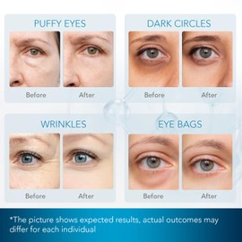 Under Eye Patches for Dark Circles: Under Eye Mask for Wrinkles - Eye Bags - Fine Lines - Puffy Eyes - Gel Mask - Amino Acid - Hydrolyzed Collagen - Anti Wrinkle Patches - Blue Eye Patches - 30 Pairs