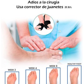 ZUBA corrector de juanetes para mujeres y hombres, kit de alivio de juanetes con separadores de dedos, férulas de juanetes y separador de dedos grandes, espaciadores y alisadores