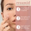 Rezamid Acne Spot Treatment Lotion For Pimples - Skin Clearing