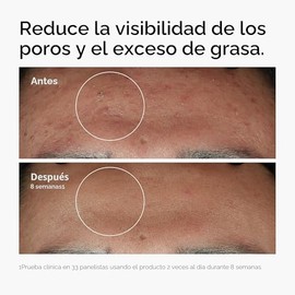 The Ordinary Niacinamide 10% + Zinc 1%, Smoothing Serum for Blemish-Prone Skin