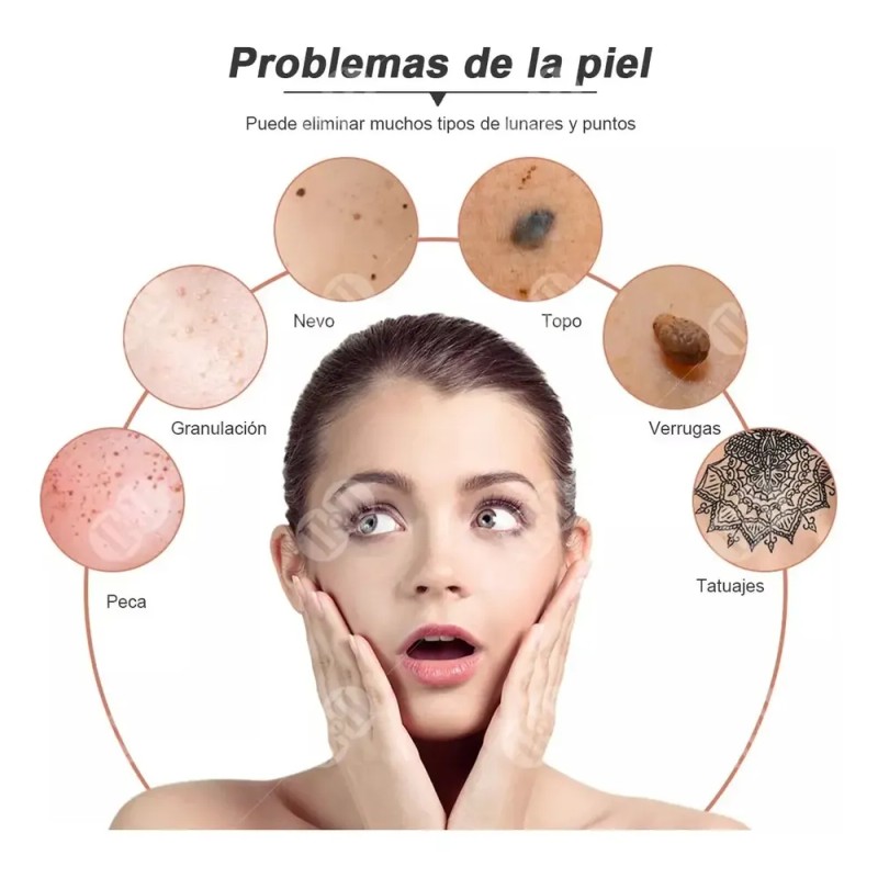 Maquina De Plasma Para Quitar Verrugas Genitales Sin Dolor