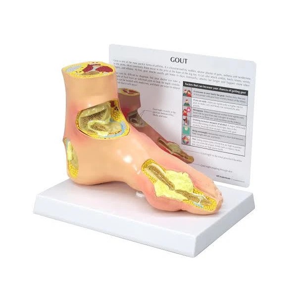 GPI Anatomicals Gout Foot Anatomical Model w Key Card LFA