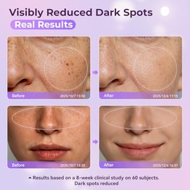 Eliminador de manchas solares, manchas de edad, manchas oscuras para rostro y cuerpo, remedio eficaz para manchas oscuras y crema corrector de manchas
