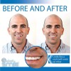 Instant Smile Temporary Tooth Kit - Pro-Series