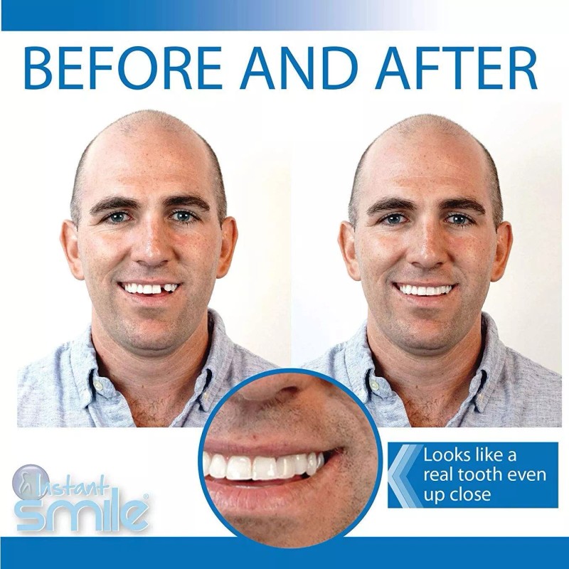 Instant Smile Temporary Tooth Kit - Pro-Series