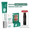 Abera Fordyce Cream - Reduce Fordyce Spots on lips, Reduce