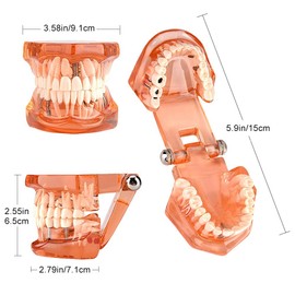 Modelo de Diente Eujgoov Modelo de Implante Dental para Enseñar Estudio de Demostración de Degeneración Dental Naranja