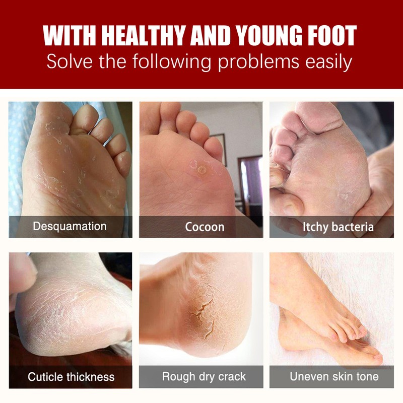 5 Pieces Exfoliating Foot Peel Mask Hydrating Moisturizing Smoothing for