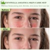 Set Mopoyat Kit Control De Acne Centella Asiatica
