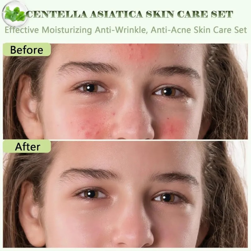Set Mopoyat Kit Control De Acne Centella Asiatica