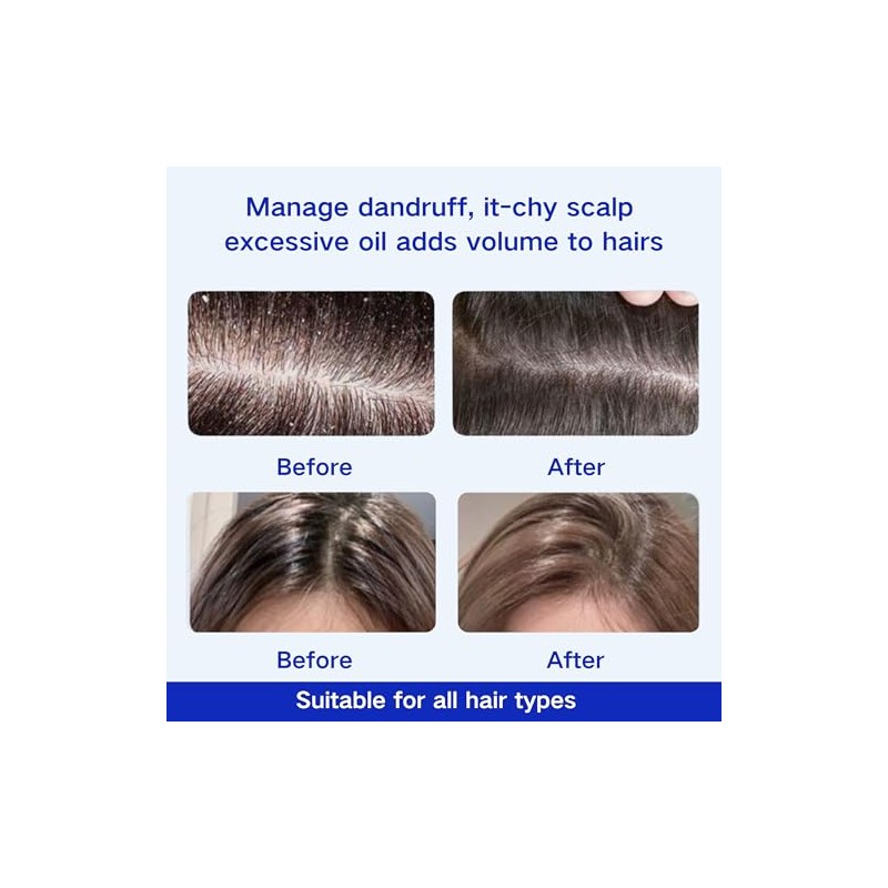 2 Pcs Anti-Dandruff Shampoo, Oil Control and Refreshing Formula, Hair