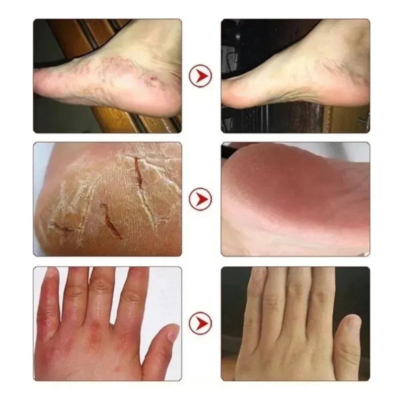 R Crema De Pies Con Hierbas Y Exfoliante Para Talones