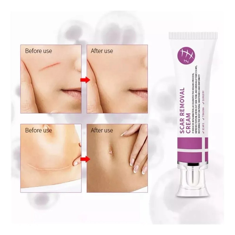 Q Crema Para Cicatrices, Crema Para Cicatrices Quirúrgicas,