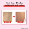 Loción corporal antimanchas TIAM cuidado del acné 6,76 fl oz