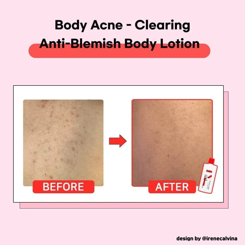 Loción corporal antimanchas TIAM cuidado del acné 6,76 fl oz