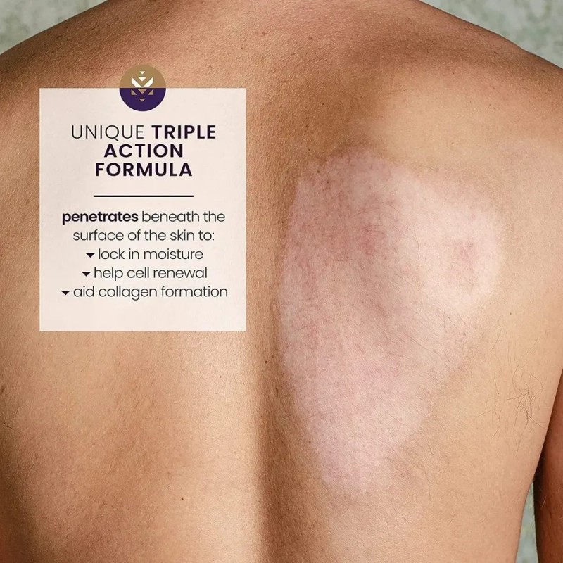 Gel para Cicatrices Mederma Advanced 50g Acné Cirugía Quemaduras