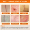 Silicone Scar Sheets (1.6"x 79" Roll-2M), Reusable Scar Silicone Strips