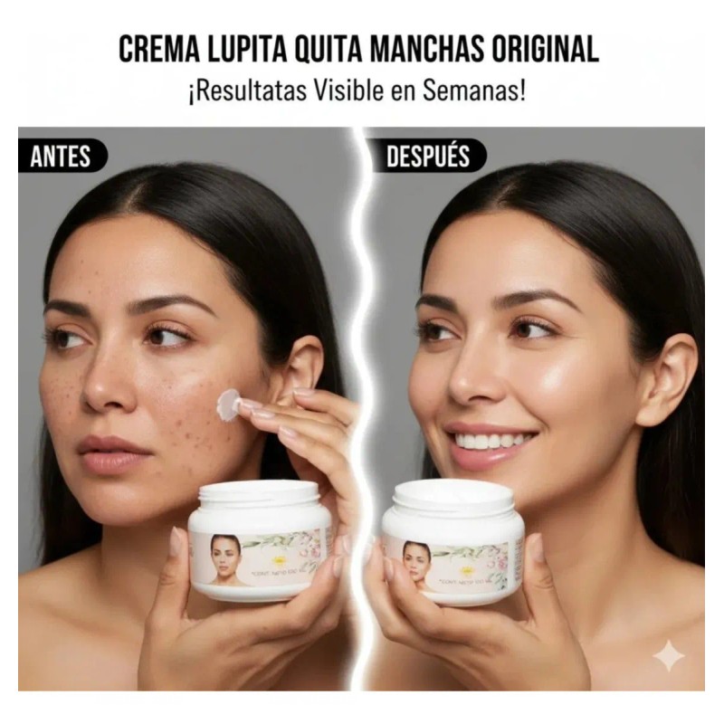 Crema Lupita Facial Acantosis Acne Anti Manchas Ros