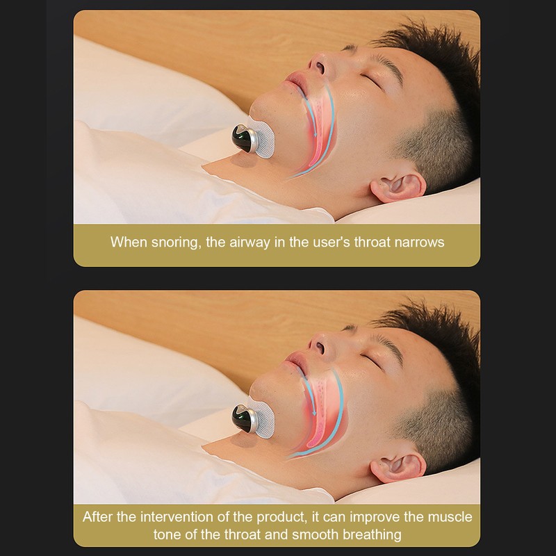 Throat Snore Device Relieve Stress Reduce Anxiety Intelligent Snoring Device