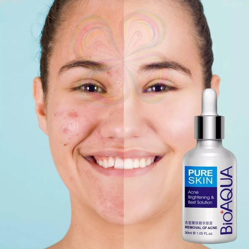 Serum Skin Care Elimina Acné Granos Espinillas Piel Facial F
