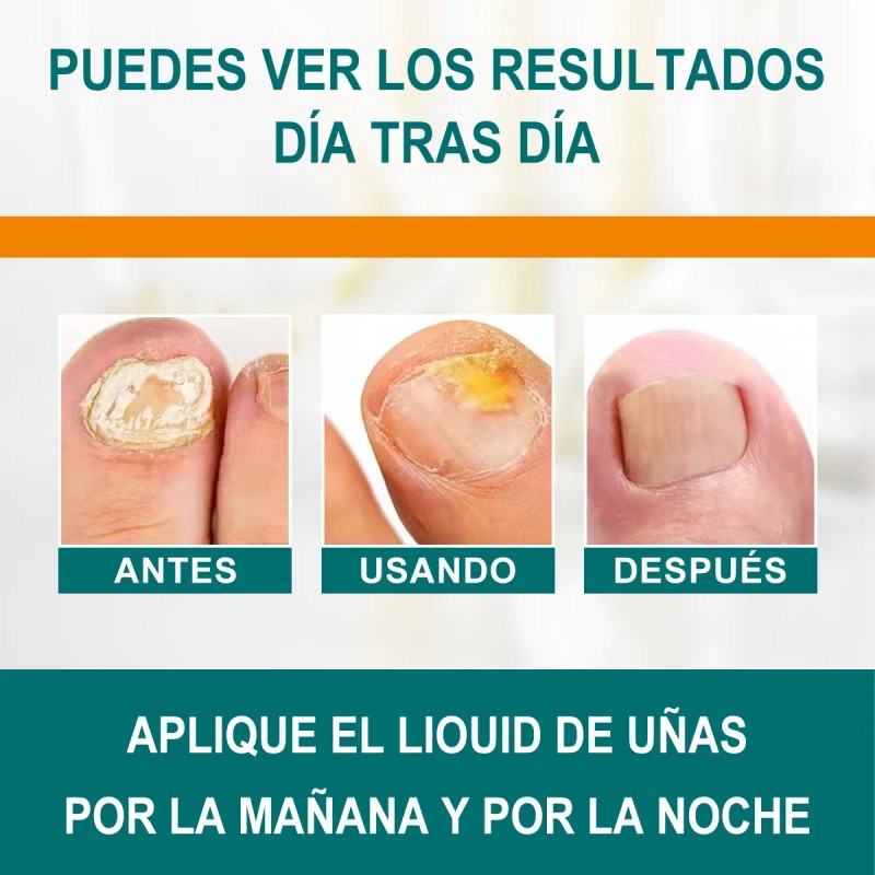 Crema Para Eliminar Hongos En Uñas De Manos , Pies