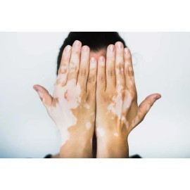 Loción Pigmentadora Temporal Skincrom. Oculta El Vitiligo 60