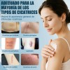 Crema Para Cicatrices, Elimina Cicatrices Y Quemaduras 20g