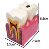 Sarini Tooth Model, Caries Comparative Study Model,Dentist Dental Anatomy Educational