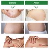 Stretch Marks Cream Prevent and Reduce Stretch Marks Pregnancy Safe