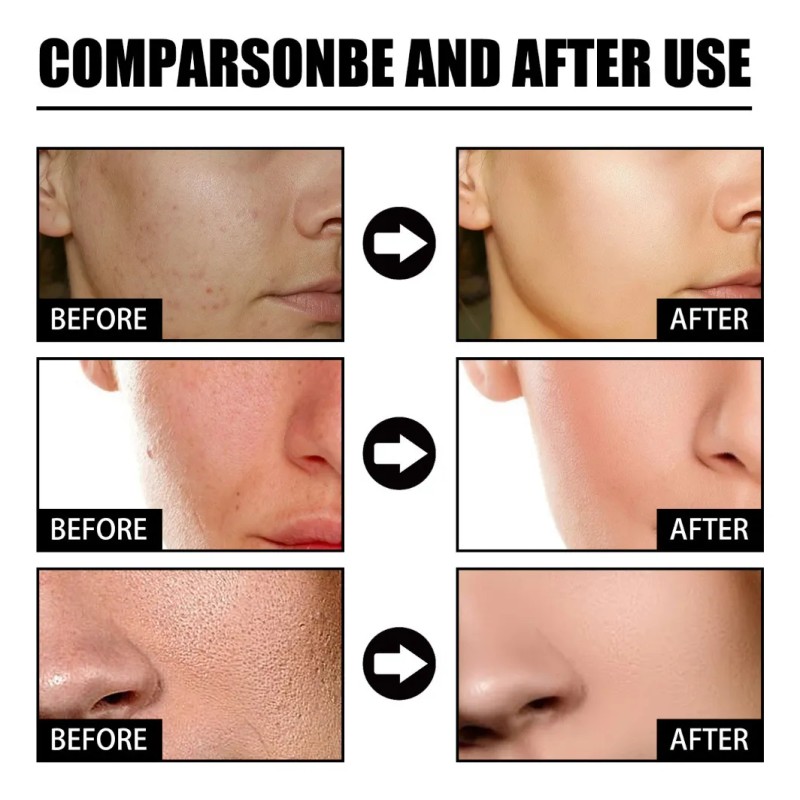 Niacina Suero Facial Desvanece Marcas De Acné Hidratación