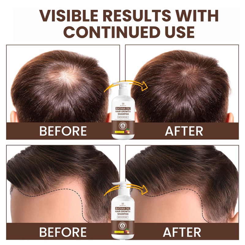Beadlamey ㅤ Batana Oil Hair Growth Shampoo: Natural Hair Loss