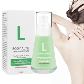 Fengyang Body Acne Serum, Exfoliating Acne Serum, Acne Cream for the Body, Body Acne Serum, Acne Repair Cream, for Removing Acne, Pimples and Acanthosis Nigricans