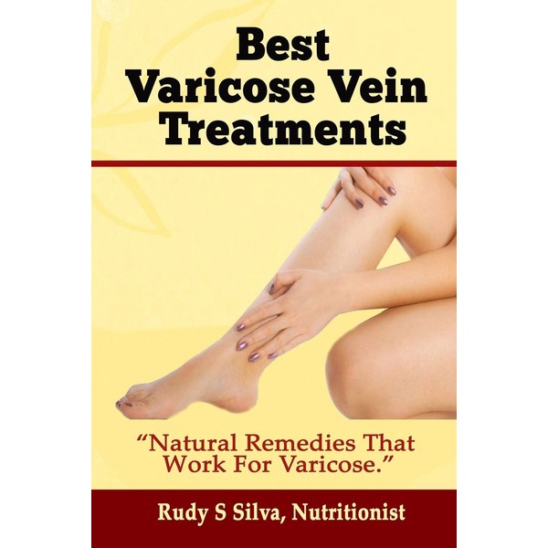 Best Varicose Vein Treatments: Natural Remedies That Work for Varicose