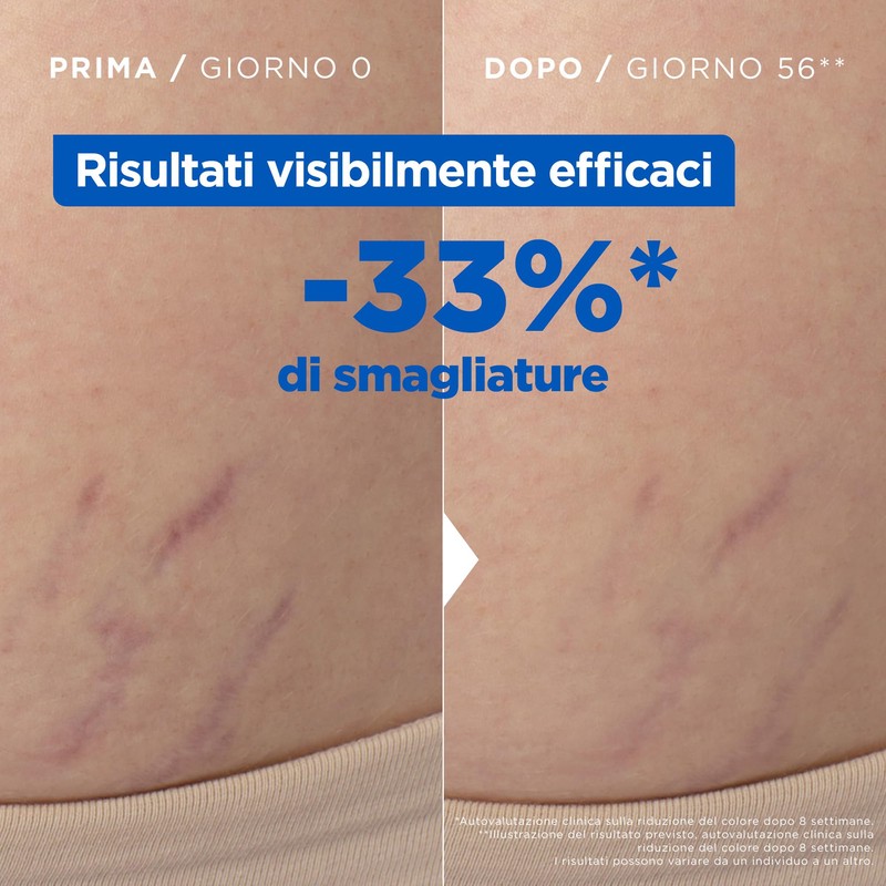 Mixa Olio Per Smagliature Nutriente, Adatto a Pelli Sensibili, Pelle