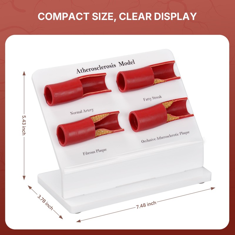 Simedutech Atherosclerosis Model, Artery Plaque Display,Vascular Disease