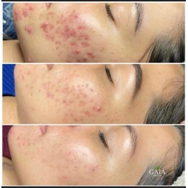 Set Tea Tree - Piel Grasa - Antiacné