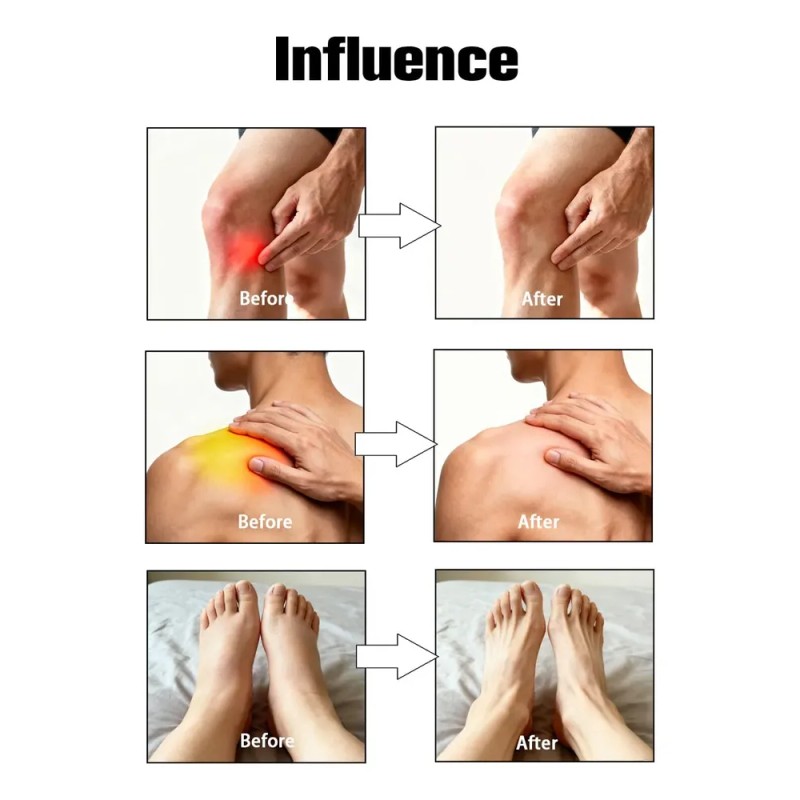 Crema De Alivio De Neuropatía Por Capsaicina | Fórmula Dirig