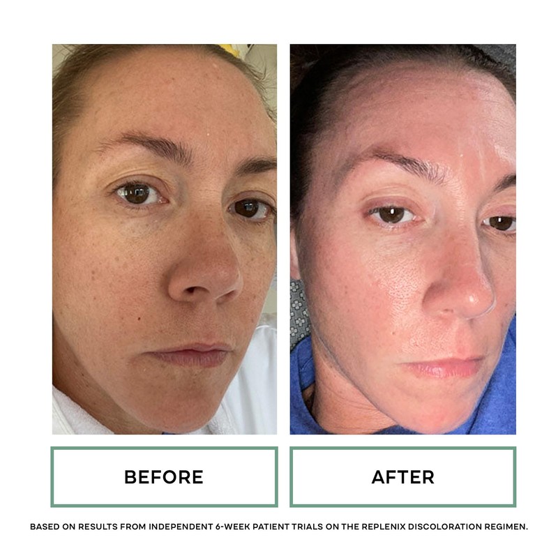 Replenix Glycolic Acid 10% Resurfacing Skin Peel, Medical-Grade Facial Peeling