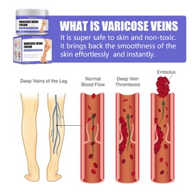 Varicose Veins Cream, Vein Ointment Varicose Veins Cream Against Spider Veins Varicose Veins and Spider Veins Removal, Leg Care Ointment for Legs, Improve the Look of the Legs and Blood Circulation