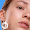 Avarelle Acne Cover Spot Patch Hydrocolloid, Tea Tree & Calendula