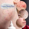 3pcs Crema Pure Skin Elimina Acné y Cicatrices Control De